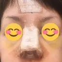 鼻尖形成（切開） / 鼻中隔延長（切開） / 軟骨移植 / 鼻尖縮小 / その他（鼻） ジョウクリニック 那覇院 DAY 4 サムネイル用