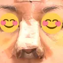 鼻尖形成（切開） / 鼻中隔延長（切開） / 軟骨移植 / 鼻尖縮小 / その他（鼻） ジョウクリニック 那覇院 DAY 5 サムネイル用