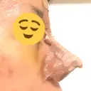 鼻尖形成（切開） / 鼻中隔延長（切開） / 軟骨移植 / 鼻尖縮小 / その他（鼻） ジョウクリニック 那覇院 DAY 5 サムネイル用