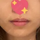 ヒアルロン酸注入（唇） ルラ美容クリニック 渋谷本院 DAY 5 サムネイル用