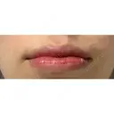 口唇縮小術 / ヒアルロン酸注入（頬） B-LINE CLINIC 池袋院 DAY 6 サムネイル用