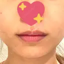 ヒアルロン酸注入（唇） ルラ美容クリニック 渋谷本院 DAY 6 サムネイル用