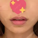 ヒアルロン酸注入（唇） ルラ美容クリニック 渋谷本院 DAY 6 サムネイル用