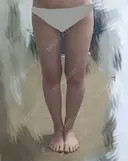 脂肪吸引（脚） / インディバ（脚） 藤・ナチュレ美容クリニック 恵比寿院 DAY 61 サムネイル用