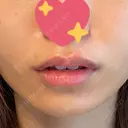 ヒアルロン酸注入（唇） ルラ美容クリニック 渋谷本院 DAY 7 サムネイル用
