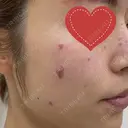 シミ取りレーザー 渋谷美容外科クリニック 新橋院 DAY 1 サムネイル用