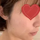 シミ取りレーザー 渋谷美容外科クリニック 新橋院 AFTER サムネイル用