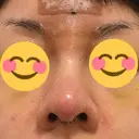 鼻尖形成（切開） / 鼻中隔延長（切開） / 軟骨移植 / 鼻尖縮小 / その他（鼻） ジョウクリニック 那覇院 DAY 7 サムネイル用