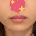ヒアルロン酸注入（唇） ルラ美容クリニック 渋谷本院 DAY 9 サムネイル用