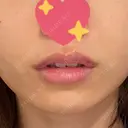ヒアルロン酸注入（唇） ルラ美容クリニック 渋谷本院 DAY 9 サムネイル用