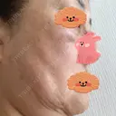 脂肪吸引（顔） / 脂肪注入（額） / 切開リフト 札幌ル・トロワ ビューティクリニックVogue DAY 64 サムネイル用
