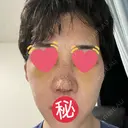 隆鼻術 / 軟骨移植 銀座S美容・形成外科クリニック DAY 5 サムネイル用