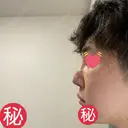 隆鼻術 / 軟骨移植 銀座S美容・形成外科クリニック DAY 6 サムネイル用