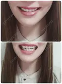 矯正（ワイヤー） ひがし矯正歯科クリニック AFTER サムネイル用