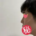 隆鼻術 / 軟骨移植 銀座S美容・形成外科クリニック DAY 8 サムネイル用