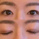 二重切開 城本クリニック 長崎院 DAY 115 サムネイル用