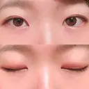 二重埋没 湘南美容クリニック 上野院 DAY 35 サムネイル用