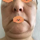 脂肪吸引（顔） / 脂肪注入（額） / 切開リフト 札幌ル・トロワ ビューティクリニックVogue DAY 70 サムネイル用