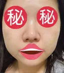 隆鼻術 / 鼻尖形成（切開） / 小鼻縮小（切開） / 軟骨移植 あいちビューティークリニック栄本院 DAY 49 サムネイル用