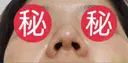隆鼻術 / 鼻尖形成（切開） / 小鼻縮小（切開） / 軟骨移植 あいちビューティークリニック栄本院 DAY 49 サムネイル用