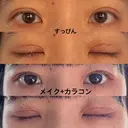 二重埋没 水の森美容クリニック 東京新宿院 DAY 4 サムネイル用