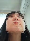 鼻尖形成（切開） / 鼻尖縮小 / ヒアルロン酸注入（鼻） 東京形成美容外科 船橋院 DAY 10 サムネイル用