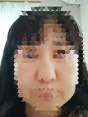 鼻尖形成（切開） / 鼻尖縮小 / ヒアルロン酸注入（鼻） 東京形成美容外科 船橋院 DAY 10 サムネイル用