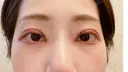 二重埋没 湘南美容クリニック 辻堂アカデミア DAY 2 サムネイル用