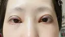 二重埋没 湘南美容クリニック 辻堂アカデミア DAY 2 サムネイル用