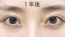 二重切開 / 上まぶたたるみ取り R.O.clinic AFTER サムネイル用