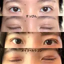二重埋没 水の森美容クリニック 東京新宿院 DAY 6 サムネイル用