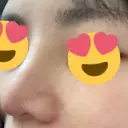 隆鼻術 / 軟骨移植 フェアクリニック川口 DAY 8 サムネイル用