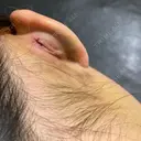 隆鼻術 / 軟骨移植 フェアクリニック川口 DAY 10 サムネイル用