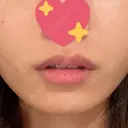 ヒアルロン酸注入（唇） ルラ美容クリニック 渋谷本院 AFTER サムネイル用