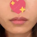 ヒアルロン酸注入（唇） ルラ美容クリニック 渋谷本院 DAY 20 サムネイル用