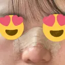 隆鼻術 / 軟骨移植 フェアクリニック川口 DAY 11 サムネイル用