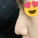 隆鼻術 / 軟骨移植 フェアクリニック川口 DAY 12 サムネイル用