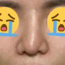 隆鼻術 / 軟骨移植 フェアクリニック川口 AFTER サムネイル用