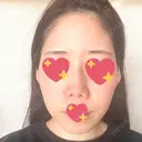 ヴェルヴェットスキン 表参道スキンクリニック 名古屋院（DAILY SKIN CLINIC提携院） DAY 3 サムネイル用