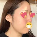 ヴェルヴェットスキン 表参道スキンクリニック 名古屋院（DAILY SKIN CLINIC提携院） DAY 3 サムネイル用