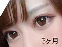 二重埋没 品川美容外科 福岡院 DAY 96 サムネイル用