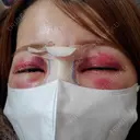 鼻尖形成（切開） / 鼻中隔延長（切開） / クマ治療 / 軟骨移植 R Beauty CLINIC 銀座院 DAY 2 サムネイル用