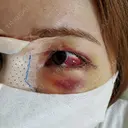 鼻尖形成（切開） / 鼻中隔延長（切開） / クマ治療 / 軟骨移植 R Beauty CLINIC 銀座院 DAY 4 サムネイル用