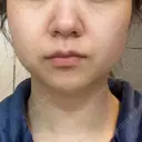 脂肪溶解注射（顔） 湘南美容クリニック 宇都宮院 DAY 21 サムネイル用