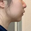 脂肪溶解注射（顔） 湘南美容クリニック 宇都宮院 DAY 21 サムネイル用