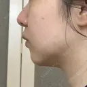 脂肪溶解注射（顔） 湘南美容クリニック 宇都宮院 DAY 21 サムネイル用