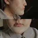 骨切り（あご） / 脂肪吸引（顔） / その他（輪郭） 銀座マイアミ美容外科 DAY 2 サムネイル用