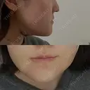 骨切り（あご） / 脂肪吸引（顔） / その他（輪郭） 銀座マイアミ美容外科 DAY 3 サムネイル用