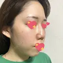 ヴェルヴェットスキン 表参道スキンクリニック 名古屋院（DAILY SKIN CLINIC提携院） DAY 5 サムネイル用