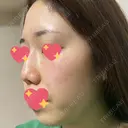 ヴェルヴェットスキン 表参道スキンクリニック 名古屋院（DAILY SKIN CLINIC提携院） DAY 5 サムネイル用